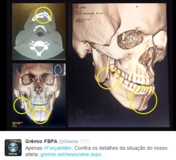Exame confirma duas fraturas na mandíbula do jogador do Grêmio Bolaños