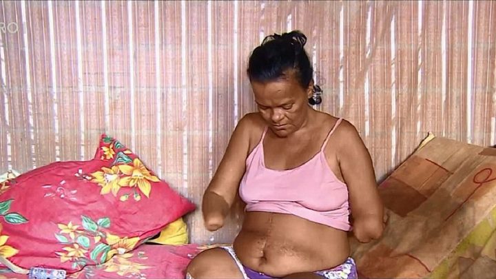 Mulher sem mãos e pernas tem pedido de benefício negado pelo INSS por não poder assinar papel