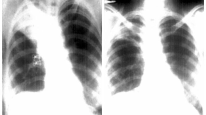 Mulher com suspeita de tuberculose descobre ter camisinha no pulmão