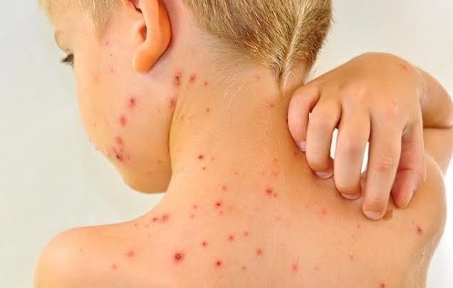 Escolas de Chapecó enfrentam surto de doença viral “mão-pé-boca”