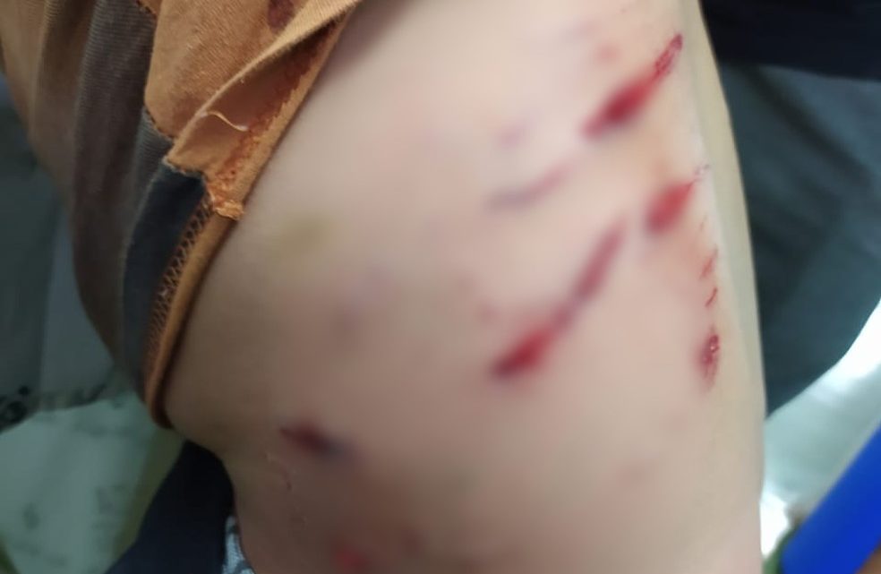 Vídeo: criança de 7 anos é atacada por cachorros na frente de casa em SC