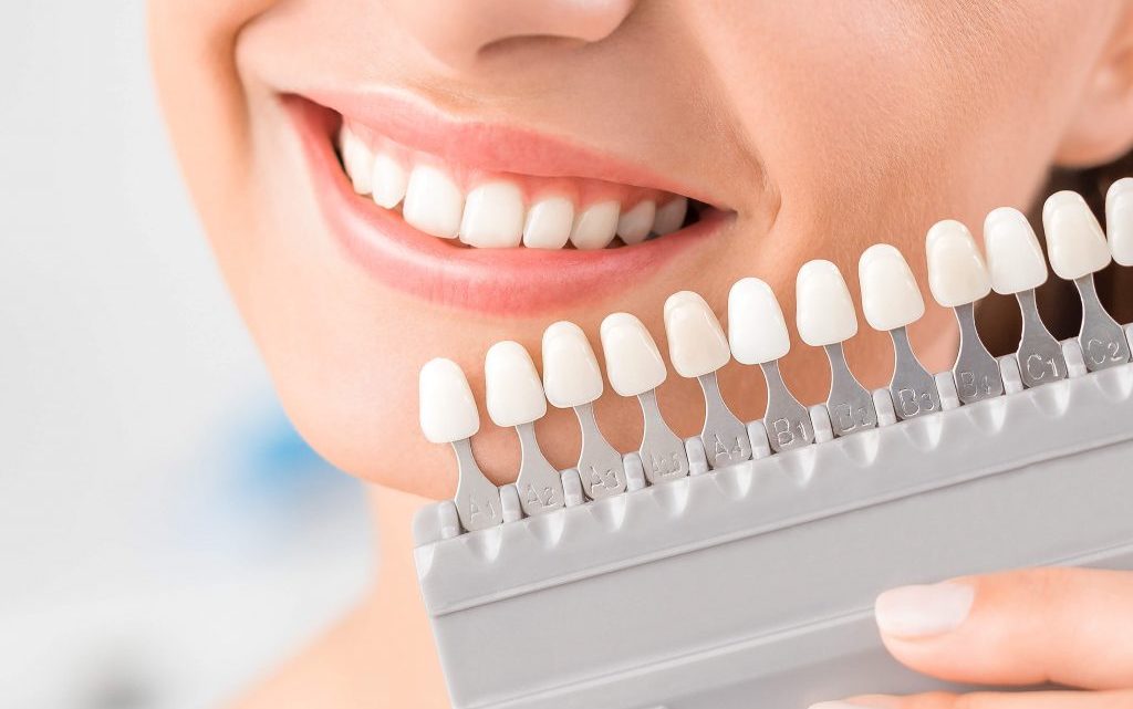 Facetas de porcelana: naturalidade e harmonia do sorriso