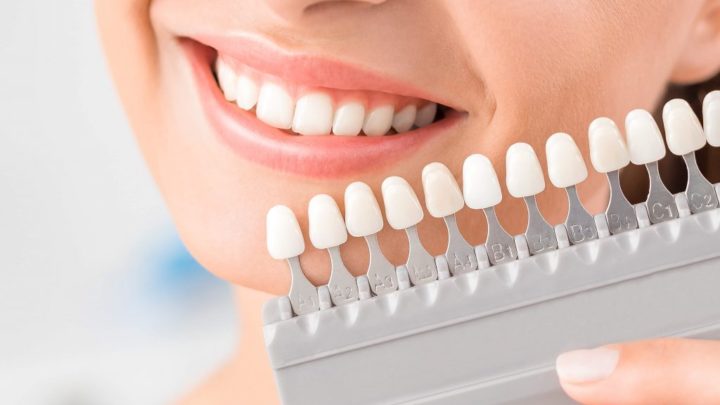 Facetas de porcelana: naturalidade e harmonia do sorriso