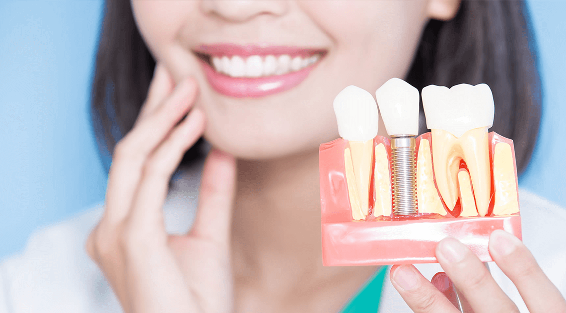 Implante dentário – um procedimento que pode salvar seu sorriso