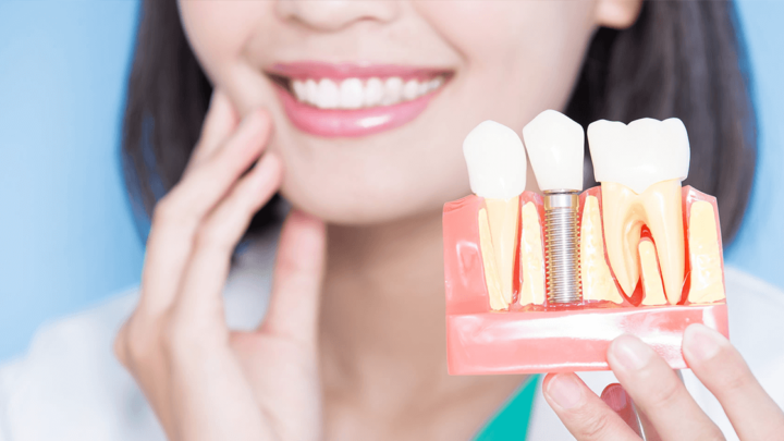 Implante dentário – um procedimento que pode salvar seu sorriso