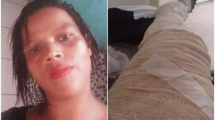 Com aumento do gás, mulher usa álcool para cozinhar e tem 85% do corpo queimado