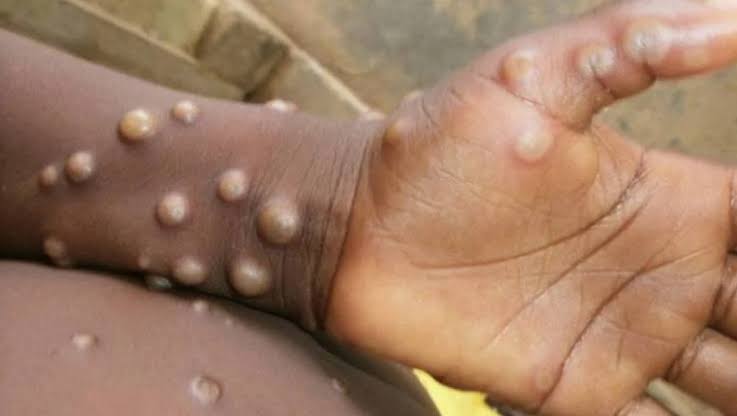 Secretaria de Saúde informa caso suspeito de “varíola dos macacos” no Oeste de SC