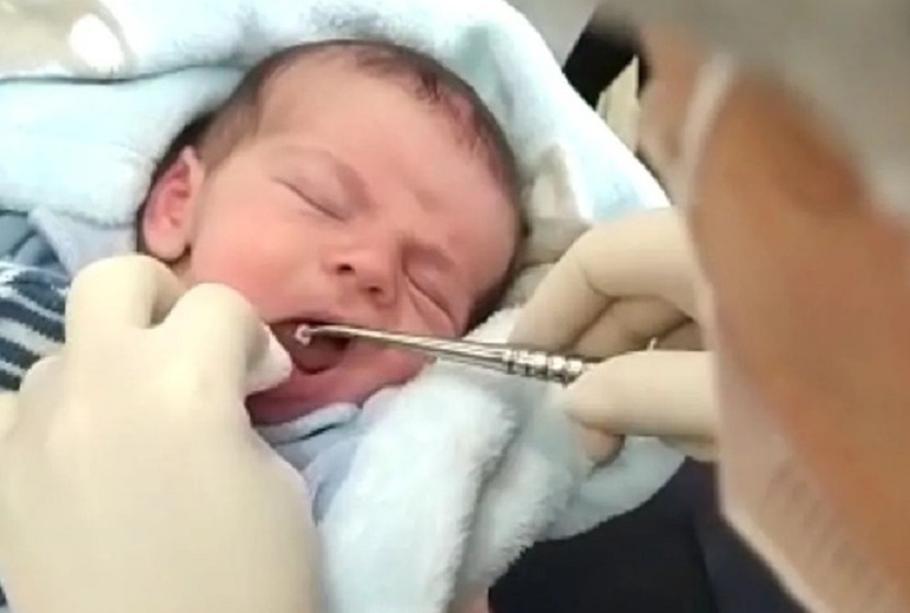 Vídeo: mãe se surpreende ao ver dente crescer em bebê de sete dias em SC
