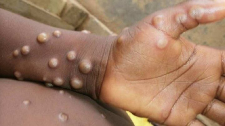 Brasileiro é primeiro infectado por varíola dos macacos na Alemanha