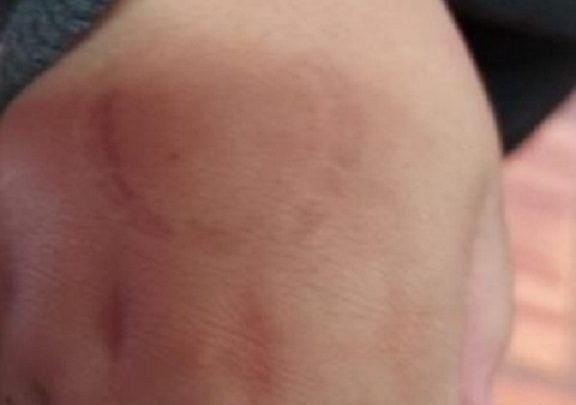 Diretora de escola morde a mão de criança de quatro anos