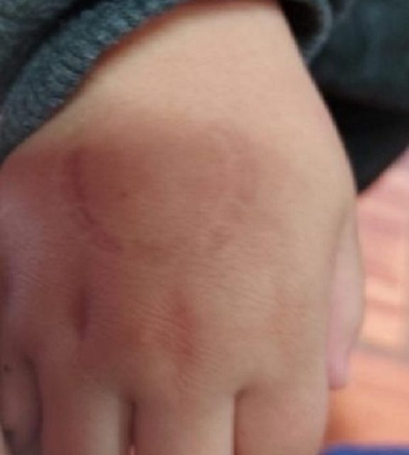Diretora de escola morde a mão de criança de quatro anos