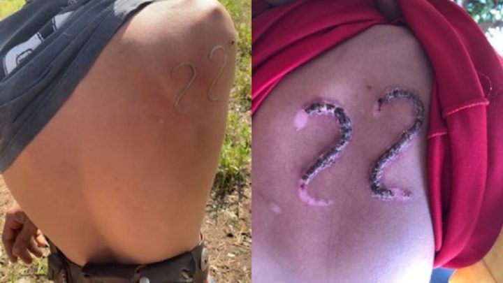 Adolescente usa ferro em brasa para “tatuar” 22 de Bolsonaro nas costas