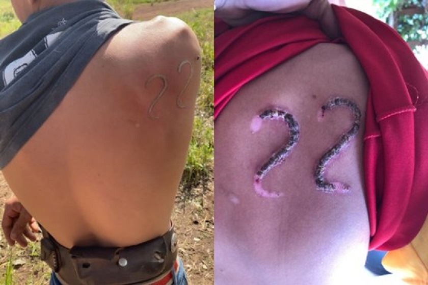 Adolescente usa ferro em brasa para “tatuar” 22 de Bolsonaro nas costas