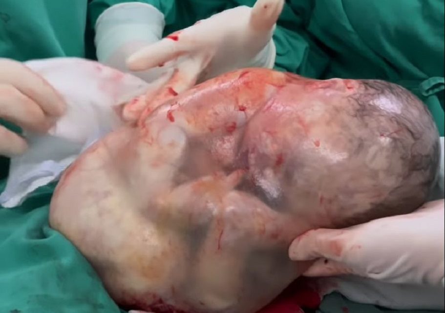 Vídeo: bebê nasce ainda dentro da bolsa amniótica e pai faz pedido especial