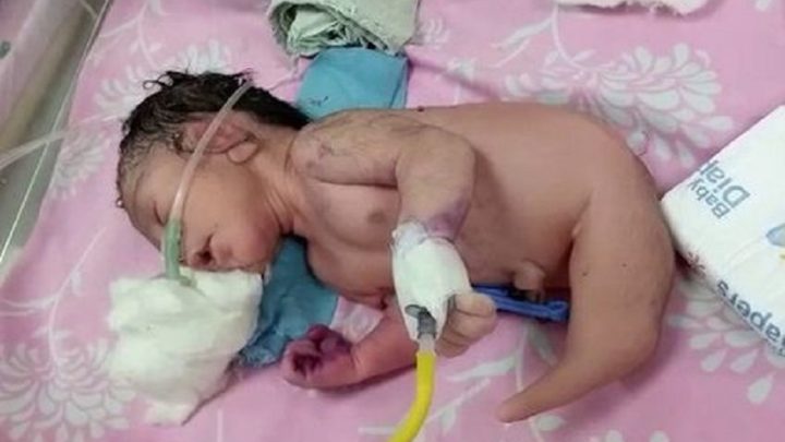Bebê nasce com “cauda de sereia” e chama atenção da medicina por condição rara