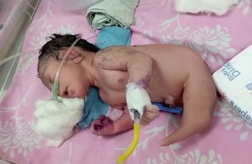 Bebê nasce com “cauda de sereia” e chama atenção da medicina por condição rara
