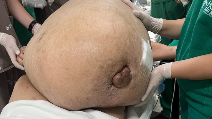 Mulher descobre tumor gigante de 46kg após cirurgia