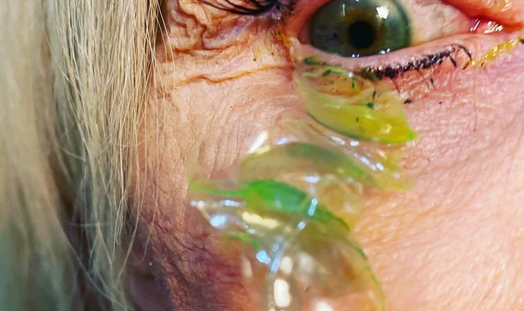 Vídeo: médica remove 23 lentes de contato de olho de paciente; entenda