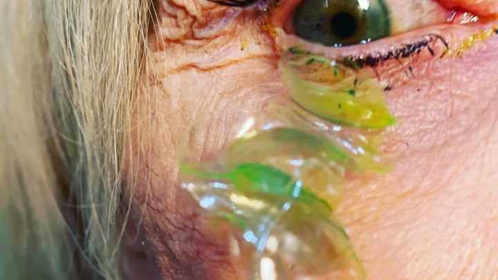 Vídeo: médica remove 23 lentes de contato de olho de paciente; entenda