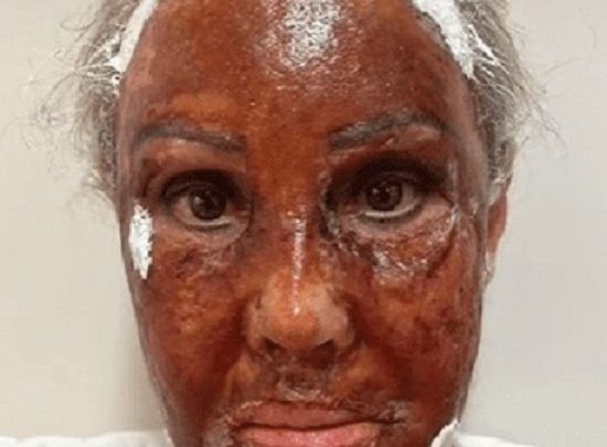 Vídeo: mulher tem rosto queimado durante procedimento estético