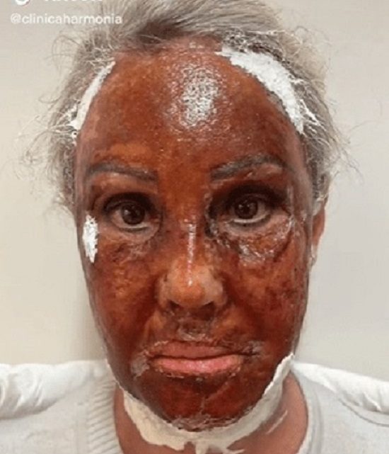 Vídeo: mulher tem rosto queimado durante procedimento estético