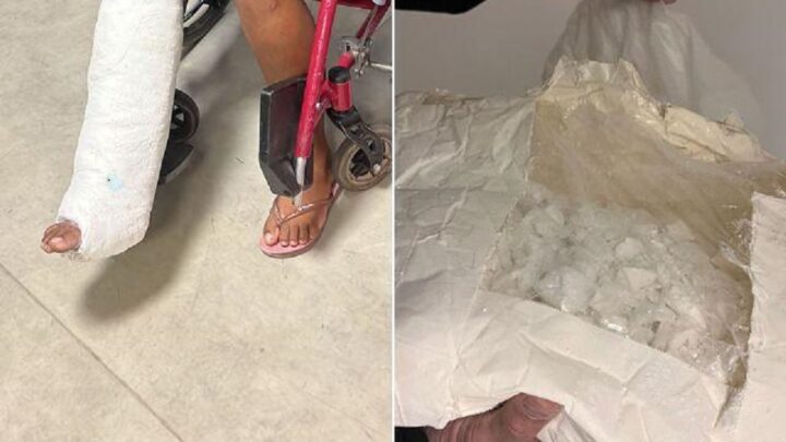 Mulher é presa com 3kg de cocaína escondida em gesso na perna