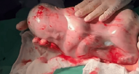 Vídeo: bebê nasce empelicado e médico o acorda com cócegas