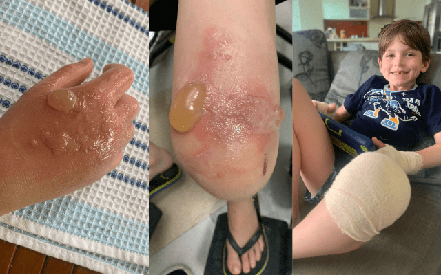 Menino sofre queimaduras graves em SC após contato com fruta que você deve ter em casa