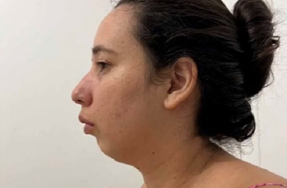 Mulher faz cirurgia no queixo e resultado impressiona: “Parecia uma tilápia”