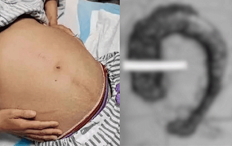 Mulher sente dor insuportável e descobre cocô gigante com 1 metro e 20 kg no intestino