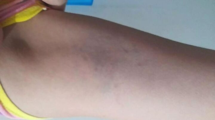 Homem é preso após agredir e morder a companheira em Concórdia