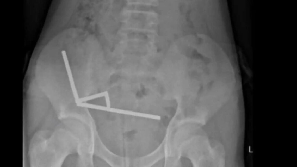 Após ingerir 100 ímãs, menino perde parte do intestino Após ingerir 100 ímãs, menino perde parte do intestino