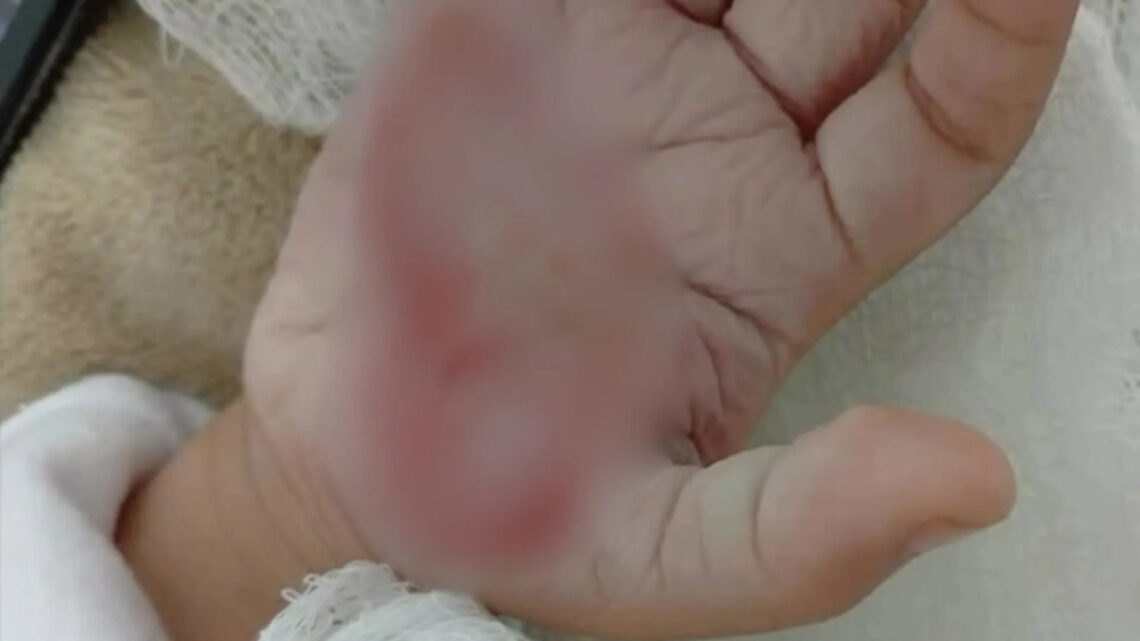 ‘Queria castigar’: mulher queima mão de criança com colher quente em SC