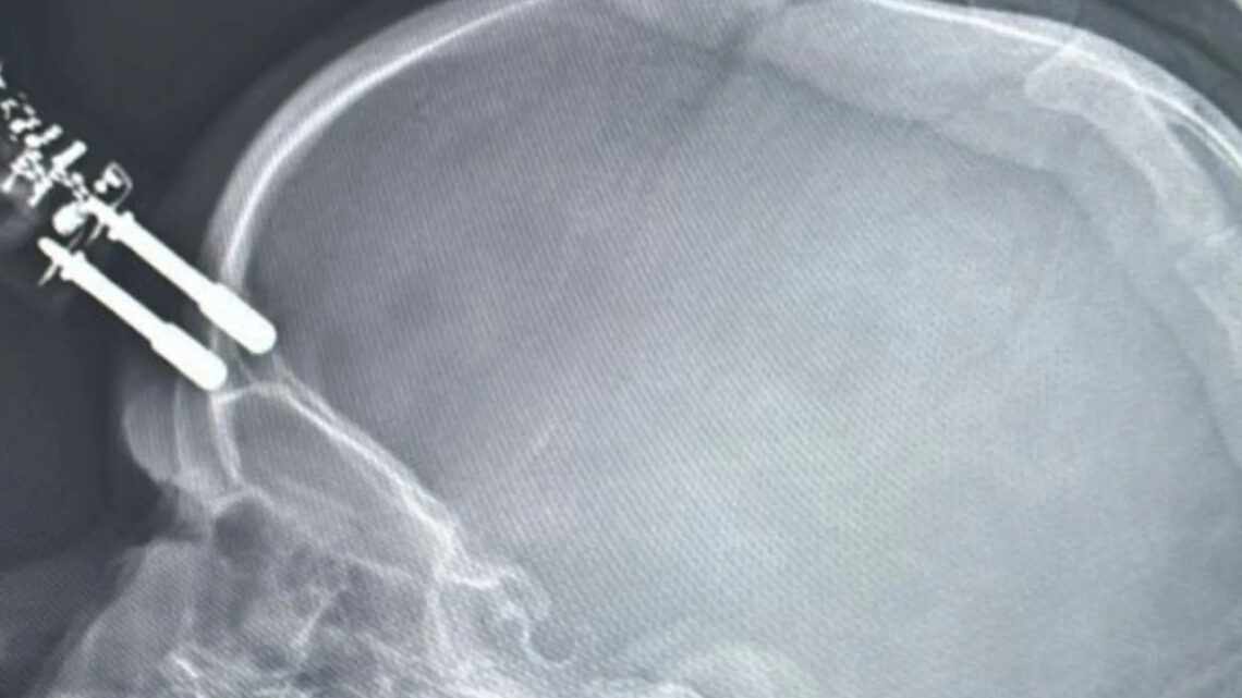 Criança cai da cama e fica com carregador cravado na testa