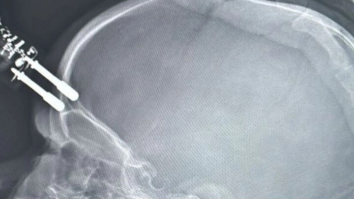 Criança cai da cama e fica com carregador cravado na testa